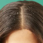 Kaşıntılı Saç Derisi ve Kepekten Nasıl Kurtulunur